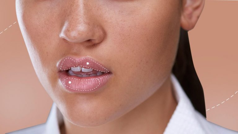 TOP 5 Most Common Lip Filler Questions