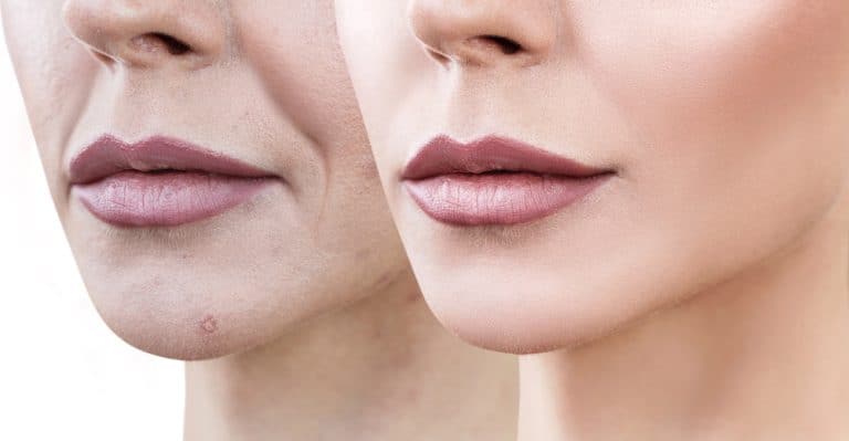 Order Revolax Online: Safe HA Dermal Fillers for Every Face