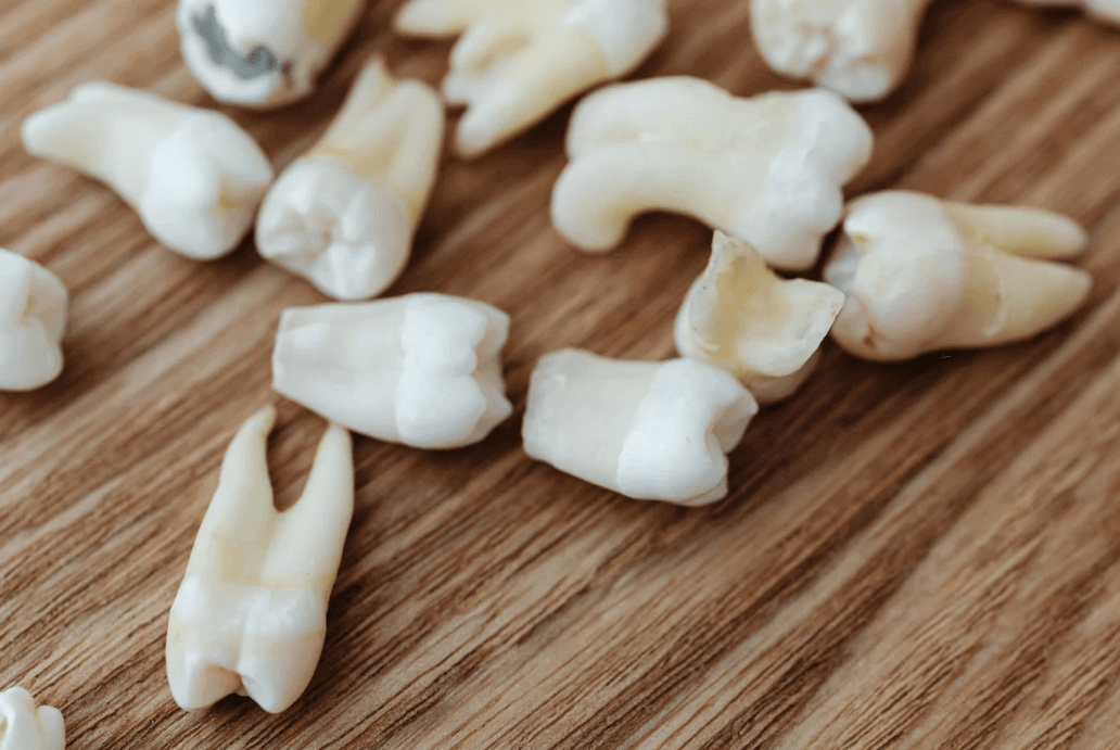 What Every Mom Should Know About Wisdom Teeth and Teen Oral Health Kelly Bejelly teeth