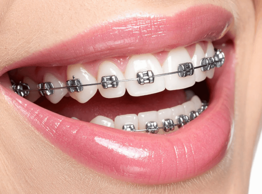 A Brighter Smile, A Bolder Presence: Women Fueling the Demand for Cosmetic Dentistry Kelly Bejelly braces