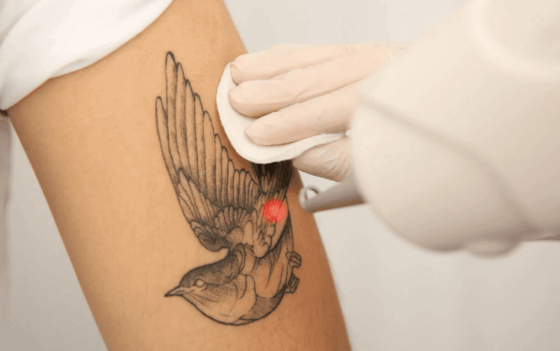 Tattoo Removal